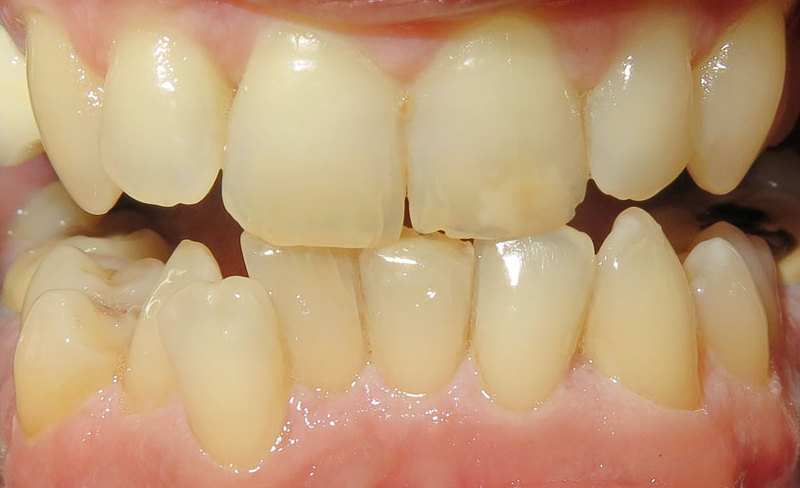 Teeth clearance